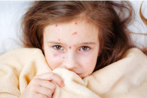 How Long Does Chickenpox Remain Contagious