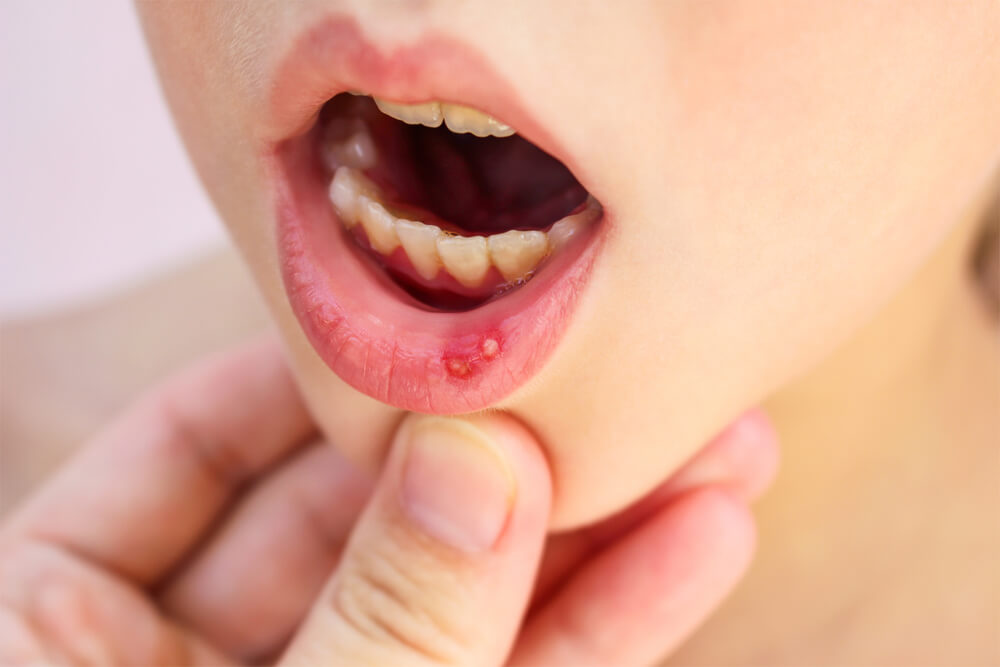 Caring for Mouth Ulcers in Children: Tips for Parents and Caregivers