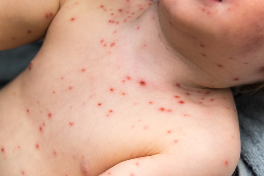 Chickenpox 101: What You Need to Know About the Itchy Rash