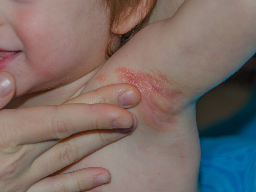Fungal Infections in Children: What Parents Need to Know 