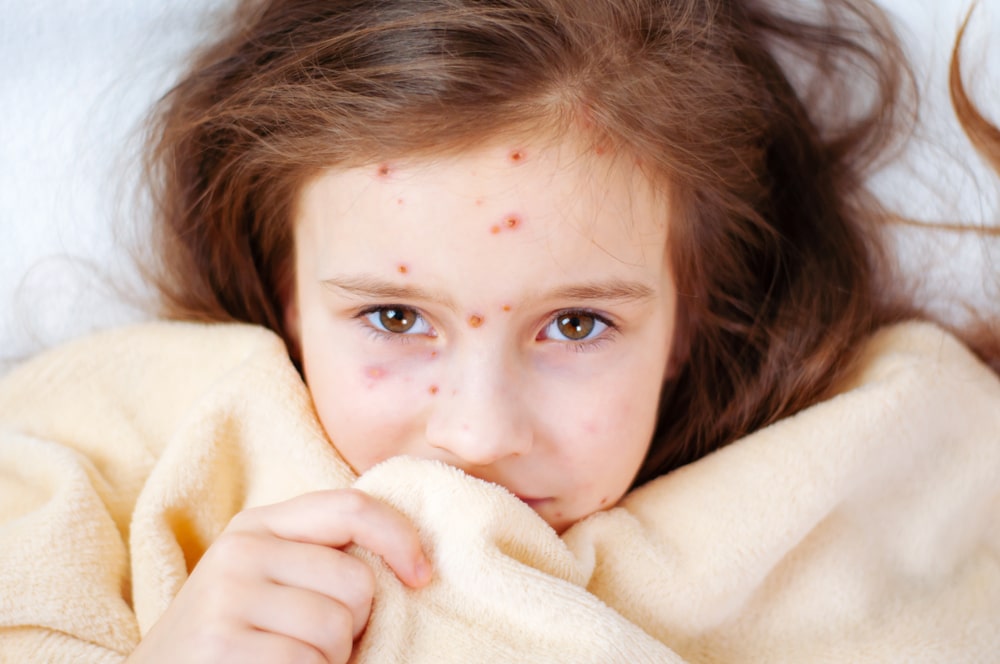 How Long Does Chickenpox Remain Contagious