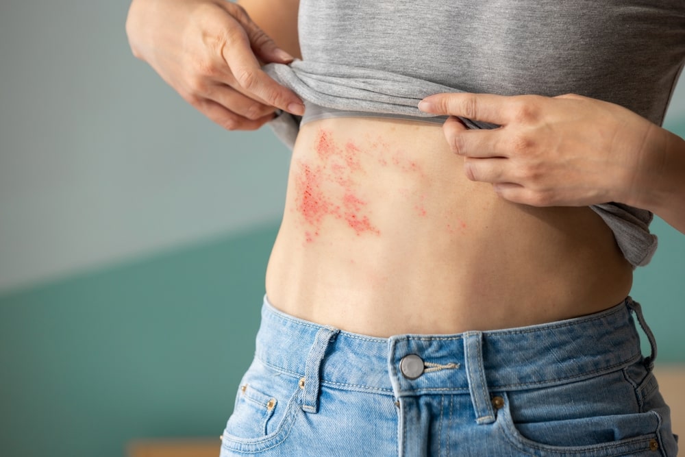 Preventing Shingles: Tips for Boosting Immunity and Reducing Risk Factors