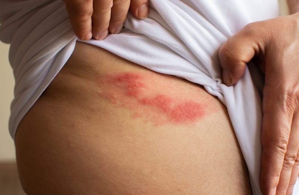 Shingles Complications: Potential Health Risks and Long-Term Effects