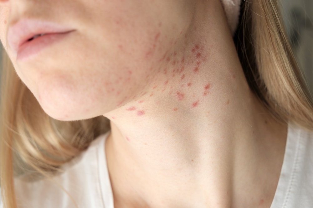 The Causes and Treatment for Comedogenic Acne