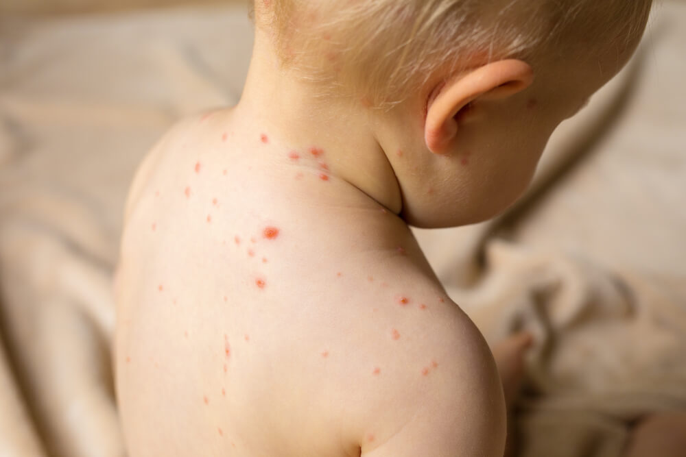 Tips for Identifying Chickenpox in Children