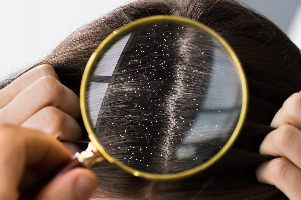 Understanding Dandruff: Causes and Treatment