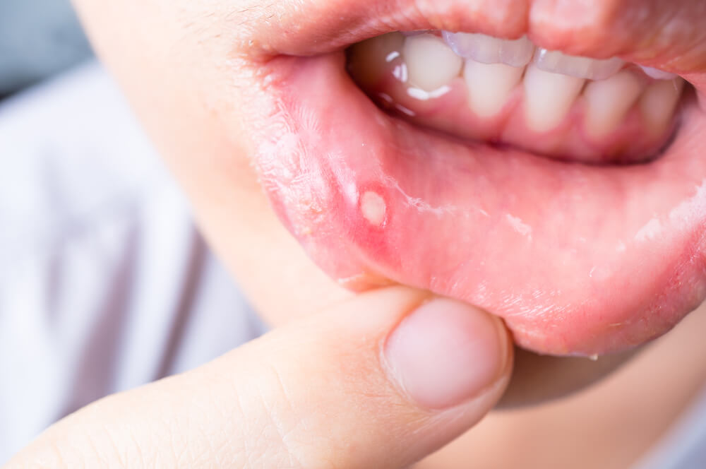 Understanding Mouth Ulcer: Causes, Symptoms, and Treatment Options