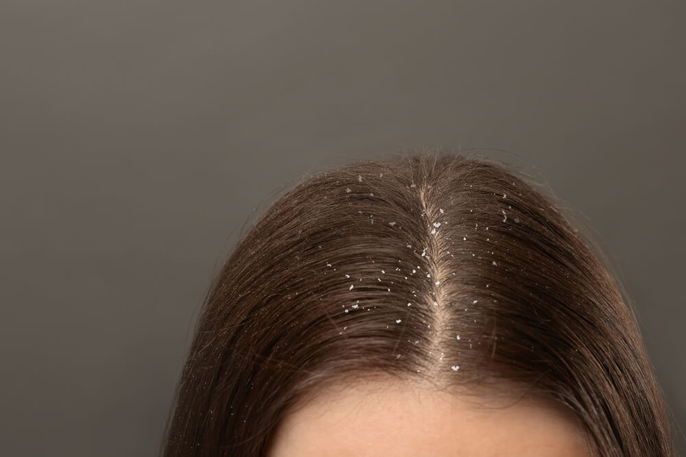 What anti-dandruff shampoo is best for hair