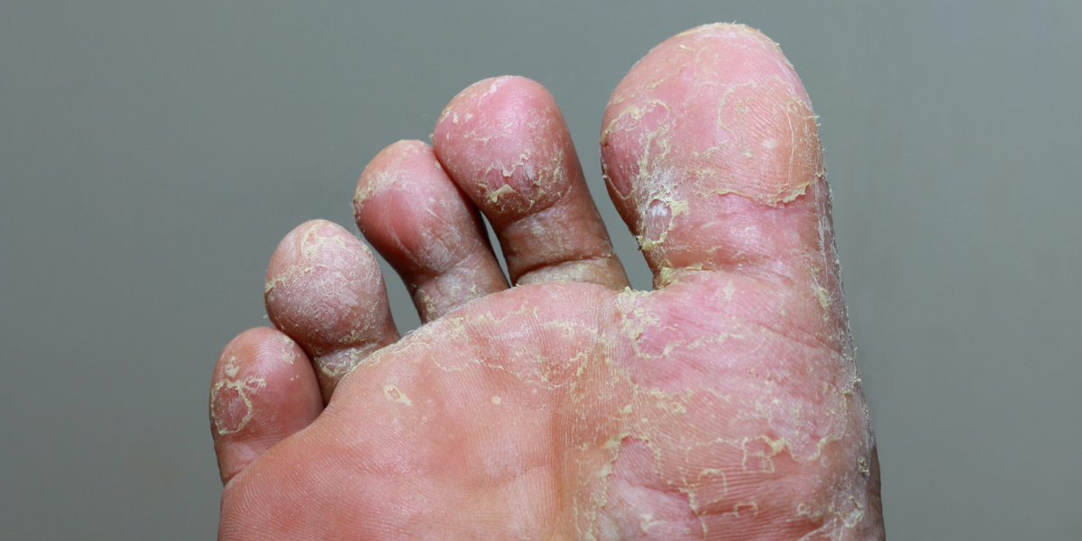 What Causes Fungal Infection on the Skin?