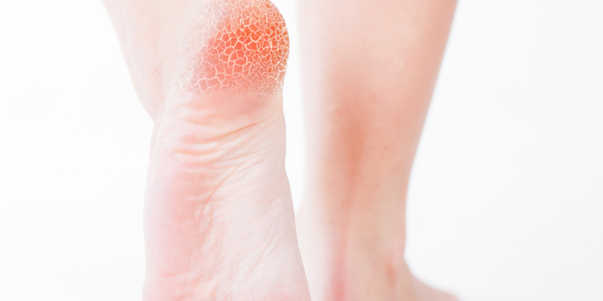 Fungal Infection: How to Get Rid of It?