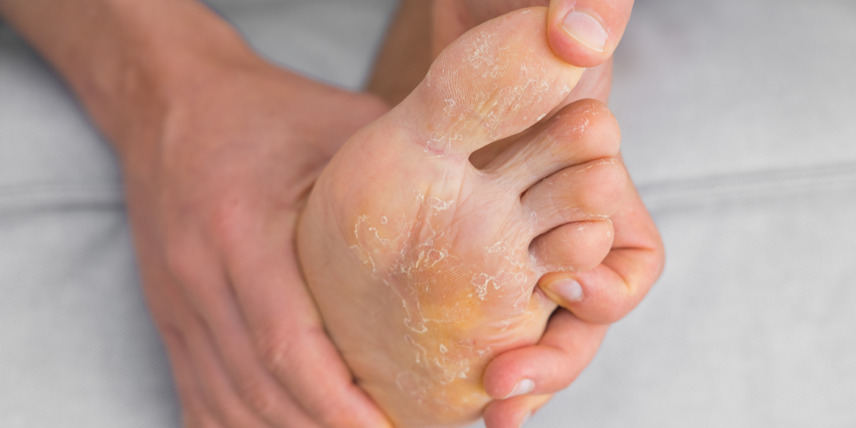 Fungal Skin Infections:  How to Treat Them?