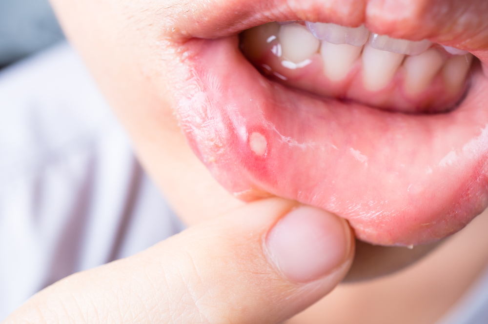 How To Use Iglu Mouth Ulcer Gel