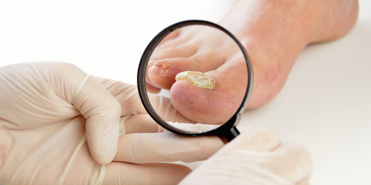 Why Can Fungal Nail Infection Be So Difficult to Cure?