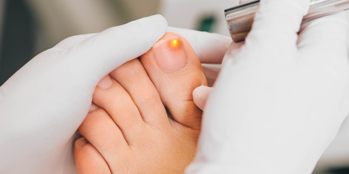 Why You Should Never Let Toenail Fungus Go Untreated?